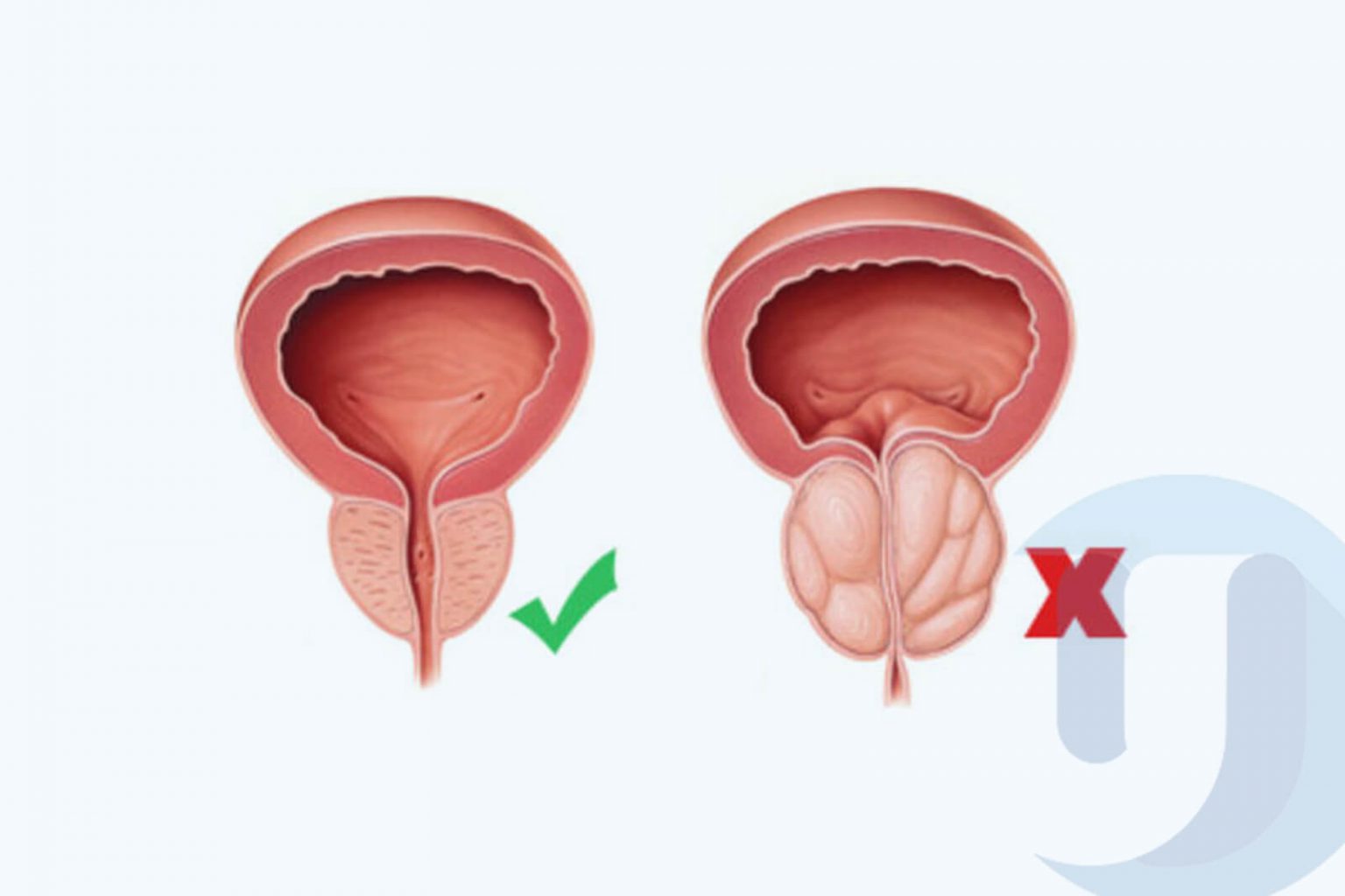 El láser prostático, la solución para la Hiperplasia Benigna de